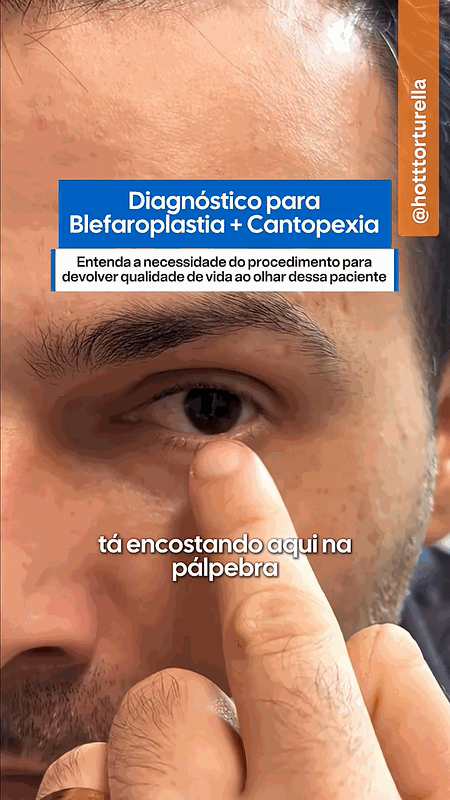 Dr. Vitor Torturella avaliando pálpebra caída que encosta no olho — Clínica Hott Torturella, Rio de Janeiro