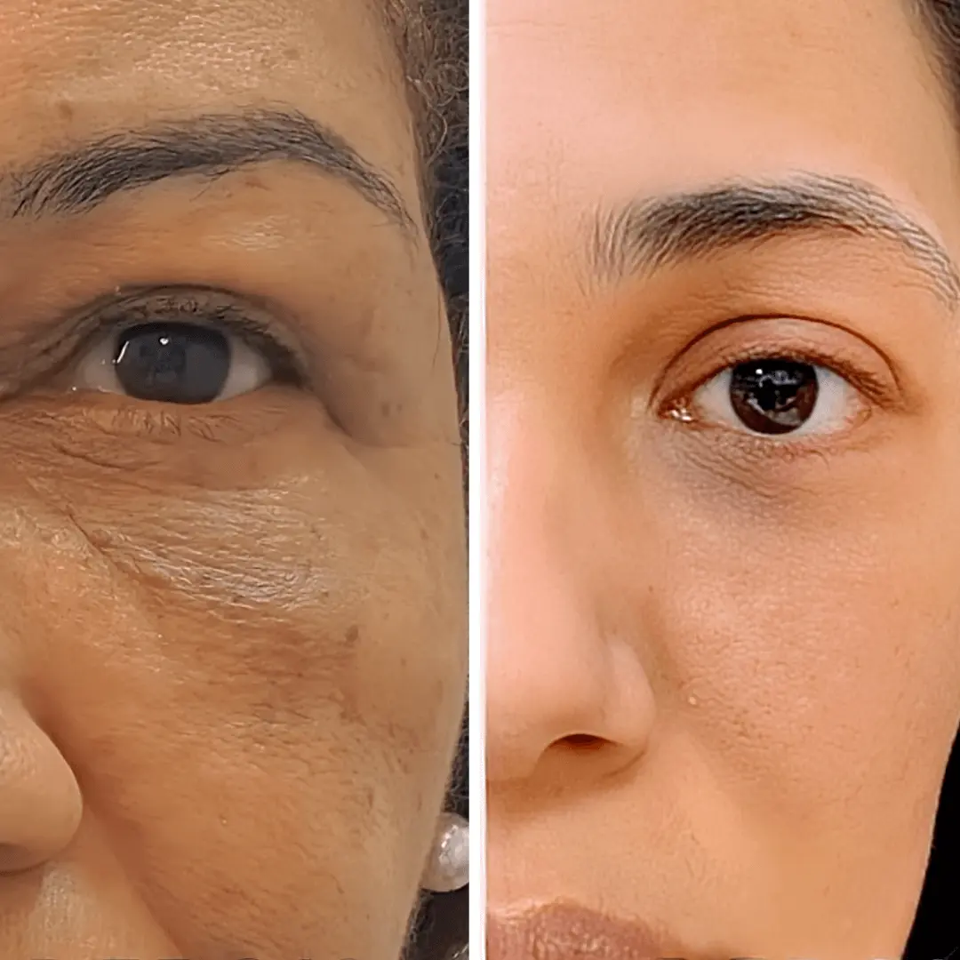 Resultado blefaroplastia pelo plano de saúde Rio de Janeiro