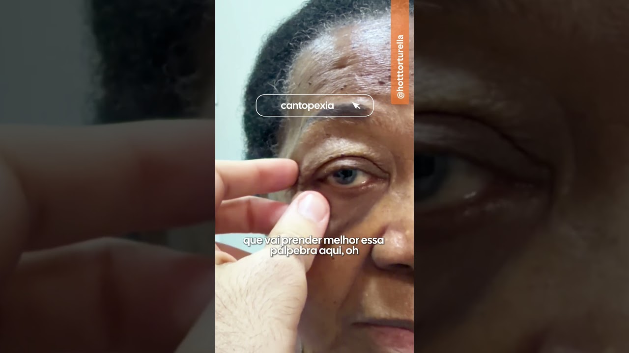 Diagnóstico de Blefaroplastia + Cantopexia em Paciente - Hott Torturella - Rio de Janeiro