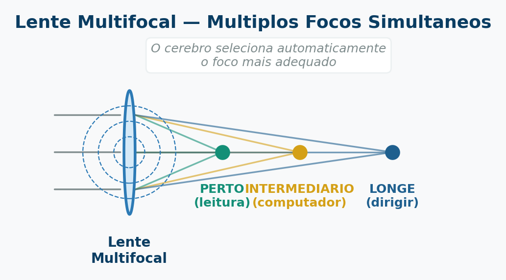 Diagrama óptico da lente multifocal para catarata: cria múltiplos focos simultâneos